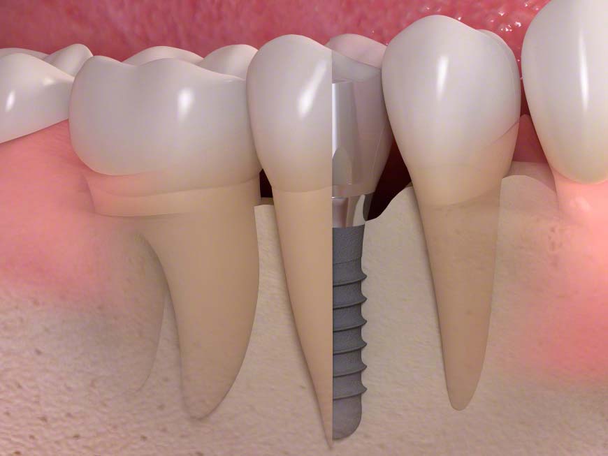 Implantate